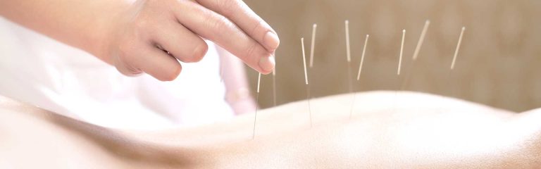 Read more about the article ฝังเข็ม (Acupuncture)