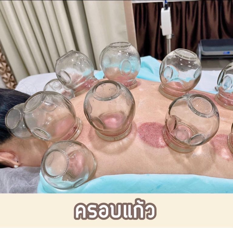 Read more about the article ครอบแก้วสำหรับนักกีฬา ช่วยอะไรได้บ้าง?