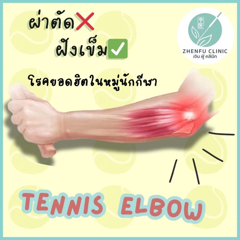 Read more about the article ฝังเข็มรักษา โรคเส้นเอ็นอักเสบ ข้อศอกด้านนอก “Tennis Elbow”