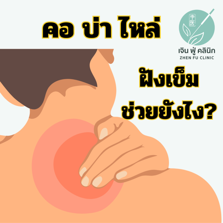 Read more about the article ปวดคอ บ่า ไหล่ ทำไมฝังเข็มถึงช่วยได้?