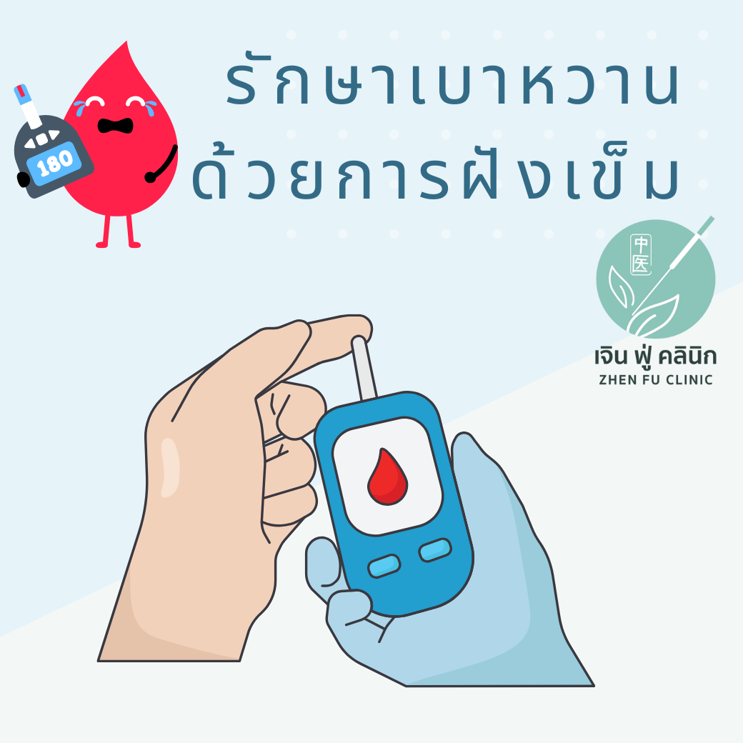 รักษาเบาหวานด้วยการฝังเข็ม เสริมสมดุลร่างกายแบบธรรมชาติ