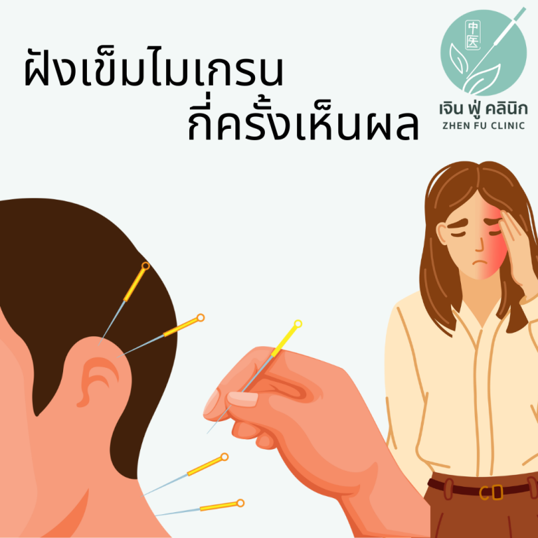 Read more about the article ฝังเข็มรักษาไมเกรน เห็นผลในกี่ครั้ง?