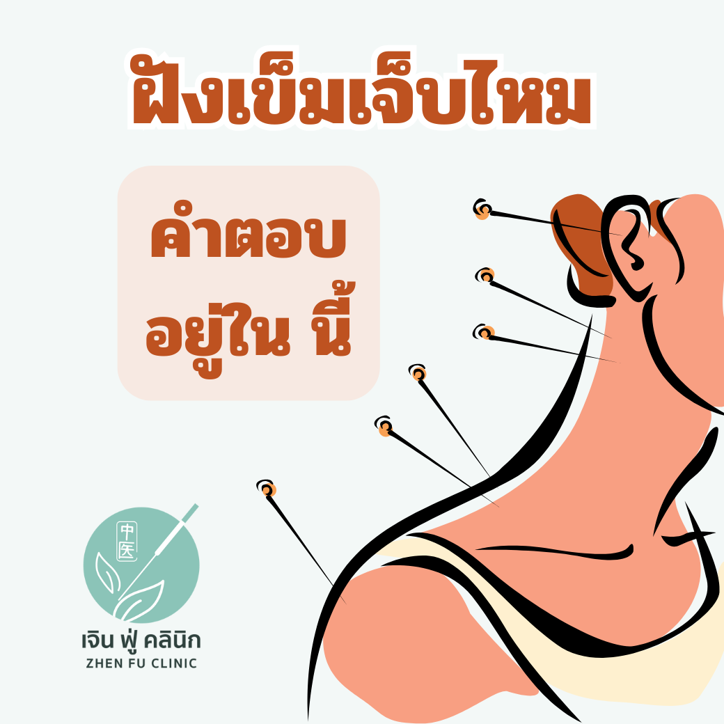 You are currently viewing ฝังเข็มเจ็บไหม?